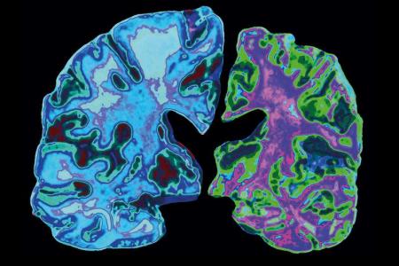 A cause & cure for Alzheimer’s Disease?