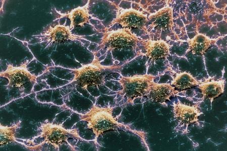 A Blood Test For Alzheimer’s, Coming Soon?
