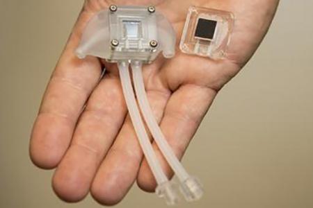 ​Artificial Kideney Helps the Fight with Dialysis!